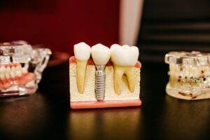 image of dental model of tooth and implant-Dental Insurance 