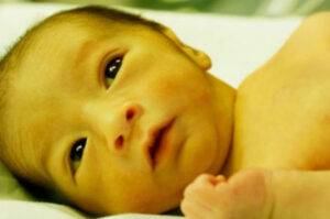 Newborn-jaundice-eyes-Bilirubin