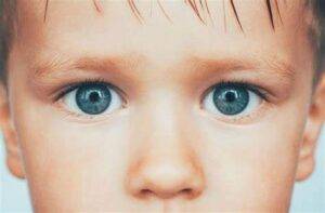 Strabismus