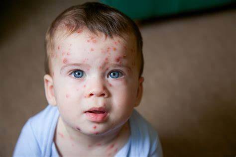 How to Look at the Chickenpox Vaccine: A Comprehensive Guide - Roswell ...